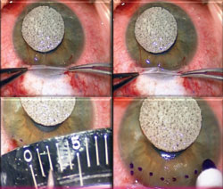 Figure 4. Top row: Amniotic membrane is folded back to expose