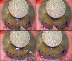 Figure 5. Pannus removal using a straight crescent blade. 