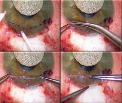 Figure 6. Amniotic membrane is attached to the peripheral cornea using fibrin glue.