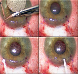 Figure 7. Top row: Excess amniotic membrane is trimmed using Vannas scissors.