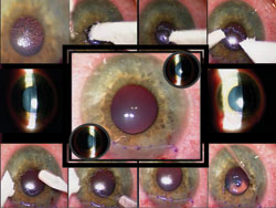 Figure 8. Corneal epithelial debridement and completed view of the procedure.