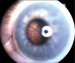 Figure 1. Amelanotic mass was visible through the pupil in the left eye.