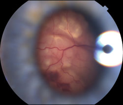 Figure 1. Amelanotic mass was visible through the pupil in the left eye.