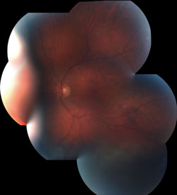 Figure 2. Choroidal mass  and an inferior exudative retinal detachment in the left eye.