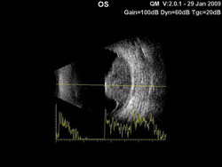 Figure 3. B- scan  demonstrated a 9.4-mm elevated choroidal lesion that was sonolucent.