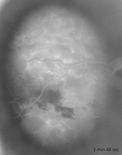 Figure 4. Fluorescein angiography  classically shows large caliber intralesional vessels 