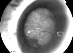 Figure 5. ICG  was performed and the lesion appeared relatively hypofluorescent.