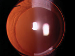 A well-centered hydrophobic acrylic IOL in the capsular bag of a 45-year-old male patient with uveitis