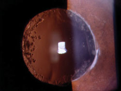 PMMA IOL implanted in the eye of a 35-year-old female with uveitis.