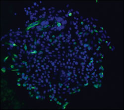 Fluorescence image of a Mel270 holoclone showing heterogeneous HMB45 protein expression (green) and nuclei stained with DAPI (blue). 