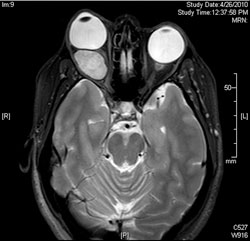 Axial MRI of the orbits with T2 fat saturation.