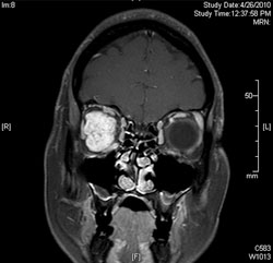 Coronal MRI of the orbits with T2 fat saturation.