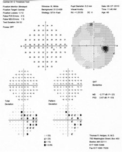 Humphrey visual field 30-2 pattern deviation of the right eye demonstrating patchy temporal field defects.