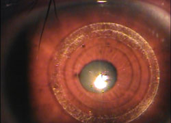 Figure 1. Intrastromal rings are placed in the cornea using the IntraLase FS laser 