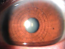 Figure 2. Clinical photograph 1 day following surgery, showing the intrastromal rings placed in the cornea using the IntraLase FS laser.