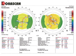 Figure 4. Orbscan topography showing steepening of the central portion of the cornea.