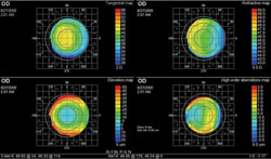 Figure 5. EyeSys topography showing steepening of the central portion of the cornea. 