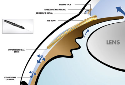 The CyPass device after insertion. Inset shows the CyPass Insertion Device. 