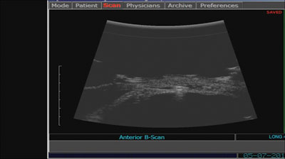 Access to the choroidal space. High-resolution ultrasound shows the aqueous lake around the shunt.