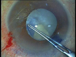 Capsulorrhexis with trypan blue in white cataract.