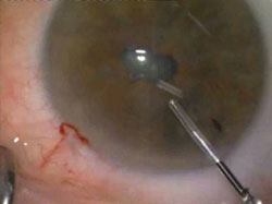 Cataract surgery in eye with small pupil, posterior synechiae and low chamber.