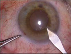 Cataract surgery in eye with pseudoexfoliation syndrome and insufficient mydriasis.