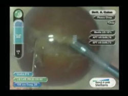 Hard nucleus, total amber cataract.