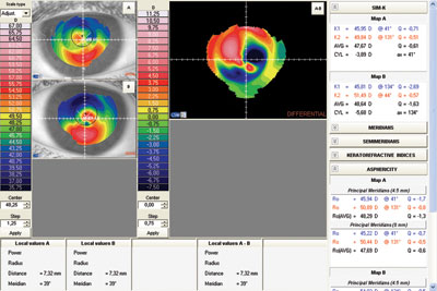 Change after reimplantation in a case of ring segment extrusion.