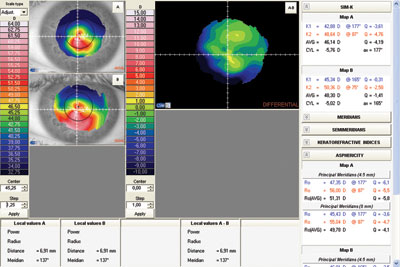 Change after reimplantation in a case of explantation due to a poor visual outcome.