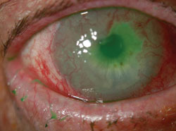 Figure 1. Right eye showing 2+ conjunctival injection