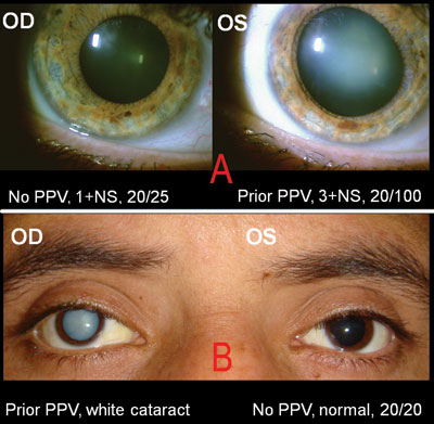 The top patient had an uncomplicated pars plana vitrectomy and gas bubble in the left eye to repair a retinal detachment.