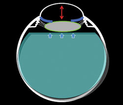  In an eye that has undergone a prior vitrectomy (right), aqueous and saline have replaced the vitreous