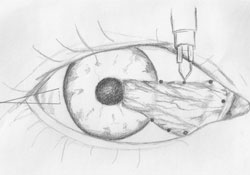 Figure 1. Schematic representation of conjunctival autograft surgical technique.