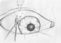 Figure 2. Following pterygium excision, the eye is rotated down and in to expose the superior temporal bulbar conjunctiva.