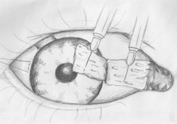 Figure 3. The conjunctival graft is appropriately positioned in the exposed scleral bed.