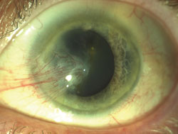 Figure 5. Clinical photographs showing a primary pterygium