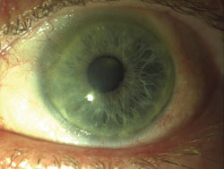 Figure 5. Clinical photographs showing a primary pterygium