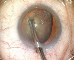 The Malyugin-Cionni ring is implanted into the capsular bag