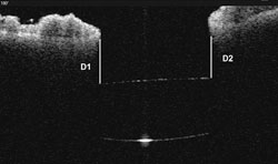 Figure 1. IOL position seen with corneal high-resolution OCT image. 