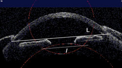 Figure 2. Anterior segment OCT analysis of IOL position. 