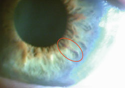 Ink markings show the steep axis and pupil centration in preparation for implantation 