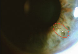 Cystotome is used to make anterior stromal puncture marks in the cornea to ensure accurate toric IOL placement