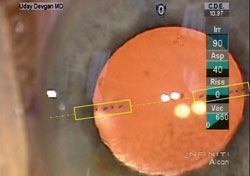 During implantation, toric IOL markings are aligned with the axis of astigmatism 