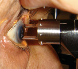 The Devgan Axis Marker has a hollow core that affords unobstructed visualization