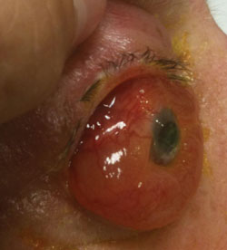 Figure 1. Proptosis, chemosis and episcleral venous congestion of the right eye.