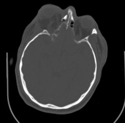 Figure 2. CT angiography scan showing proptosis and superior ophthalmic vein enlargement of the right eye