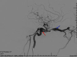 Figure 3. Angiography, lateral view, demonstrating right high-flow CCF (red arrow)  causing enlargement of the superior ophthalmic vein (blue arrow)