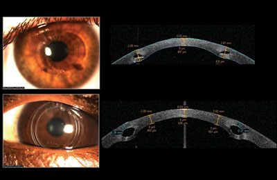 Three months postop intracorneal ring segments insertion comparing Ferrara rings above and Intacs down below, with Visante OCT.