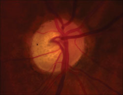 Figure 1. Optic disc photos of the right and left eyes