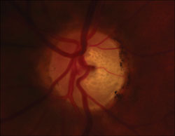 Figure 1. Optic disc photos of the right and left eyes